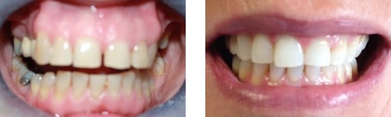 Braces Cases - Dentist Wolverhampton